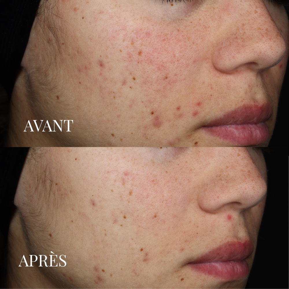 Masque Soin Détoxifiant